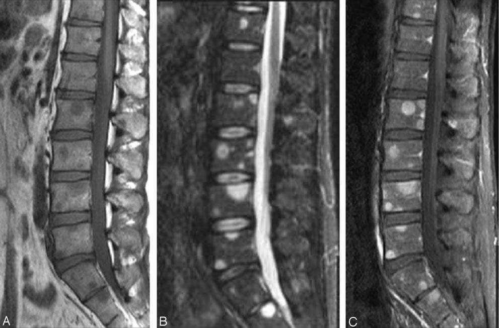 T2-weighted (B) images and diffuse abnormal enhancement after gadolinium administration (C). Note the absence of a compression deformity despite the presence of diffuse bony metastases. FIG 7.