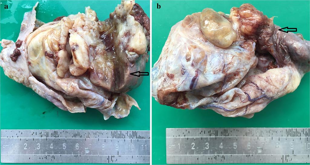 Page 2 of 6 Fig. 1 Gross specimen of ovarian cystic mass with mural nodule: a solid mural nodule protruding into the cyst indicated with black arrows (a).