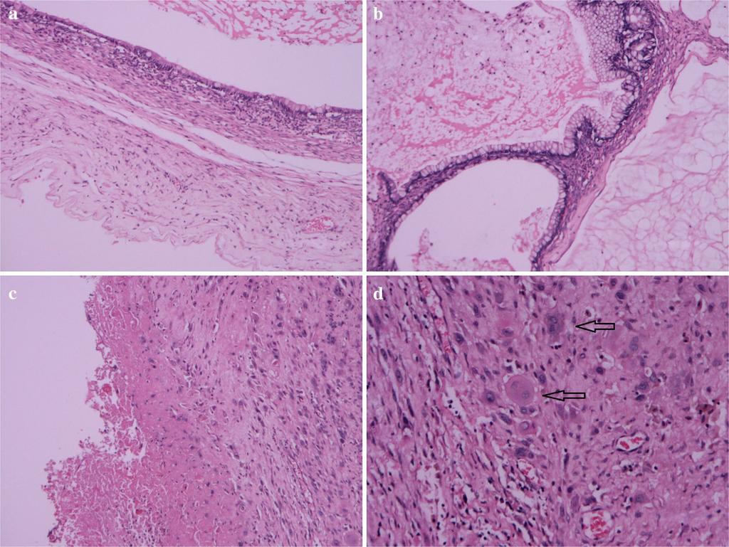 Page 3 of 6 Fig. 2 Histological findings (H&E). a Ovarian mucinous cystadenoma ( 10). b Borderline malignant mucinous cystadenoma and acellular pools of mucin ( 10).