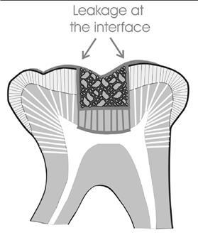 A. Microleakage greatest deficiency of dental materials. 1. Interface where the tooth & materials join; microleakage occurs between the restoration & tooth.