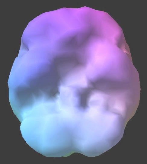 3D surface SPECT image of the brain of abstinent and ana smoker (chronic effect) normal
