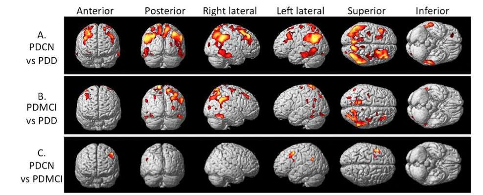 From PD to PDD PD-MCI PDD: vs PDCN: extensive bilateral areas of reduced FDG uptake in the frontal, parietal, occipital and temporal lobes and in the posterior cingulate cortex; vs PDMCI: lower