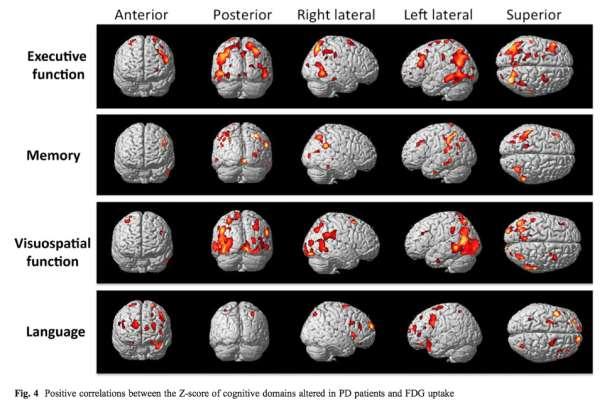 PD-MCI, PDD cognitive symptoms regional glucose metabolism correlated with executive, memory, language and visuospatial functions Executive function: parietal, frontal and occipitotemporal junction;