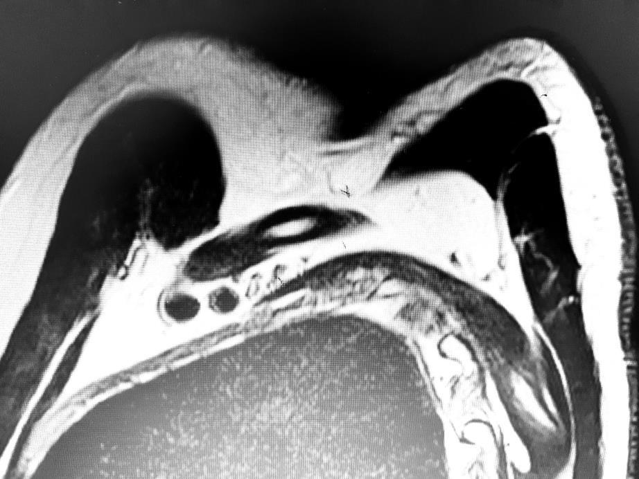 Dynamic MRI of the brachial plexus Comparison of