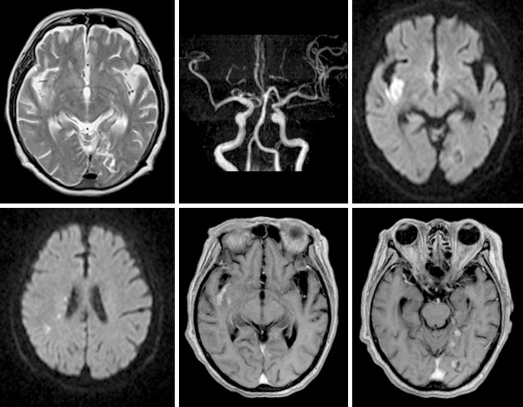 Figure 1. Magnetic resonance imaging (MRI) and MRA of the brain performed on admission (A- D) and day 9 posthospitalization (E, F).