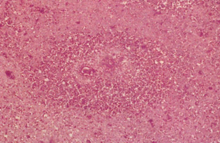 Granulomatous amoebic encephalitis formation of granulomatous lesions in CNS Chronic