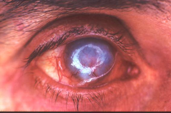 Keratitis is characterized by
