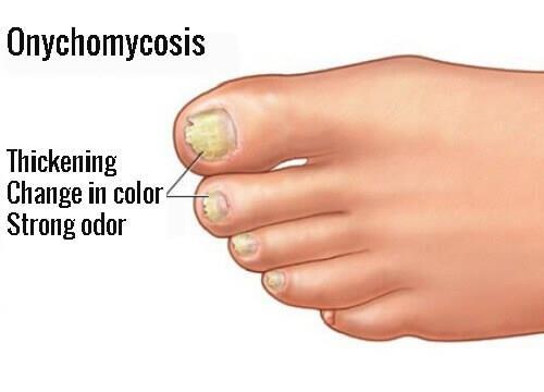 Is used in treatment of onychomycosis.
