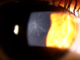 LASIK Sub-epi corneal laser treatment Approved for myopia (11.