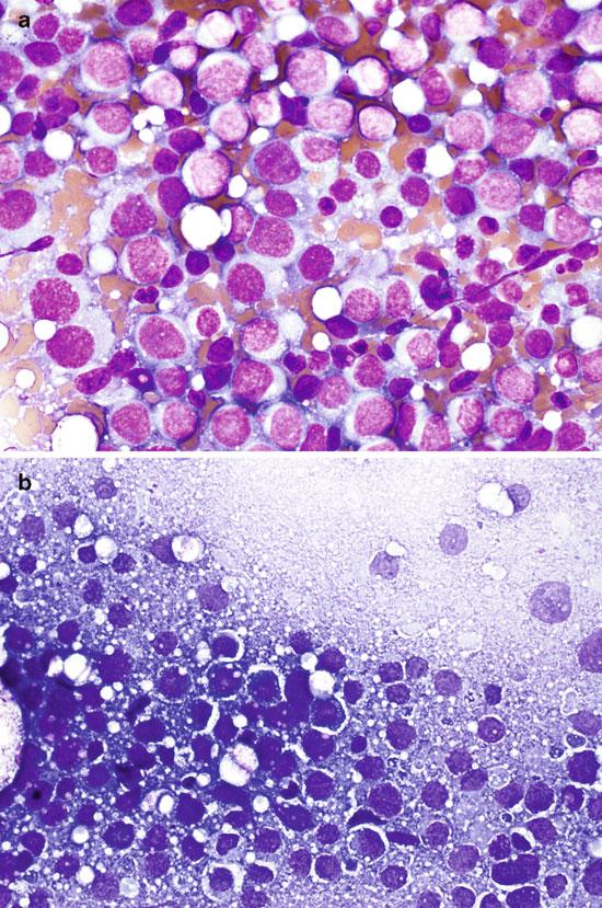 APPLICATIONS OF TOUCH PREPARATION CYTOLOGY 19 FIGURE 2.16 Touch preparation cytomorphology of erythroid sarcoma.
