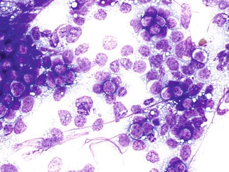 18 Touch preparation cytomorphology of Burkitt lymphoma: Cytoplasmic vacuoles.