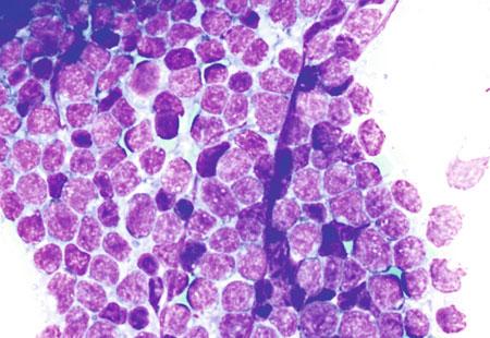 20 Touch preparation cytomorphology of B-lymphoblastic lymphoma: Sheets of lymphoblasts.