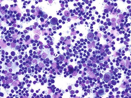 FIGURE 2.3 Touch preparation cytomorphology of lymphohistiocytic-rich large B-cell lymphoma: Rare scattered large abnormal lymphoid forms.