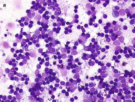 10 FROZEN SECTION LIBRARY: LYMPH NODES may also be seen in the lymphohistiocytic-rich variant of anaplastic large-cell lymphoma (ALCL).