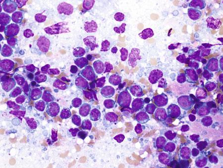 14 FROZEN SECTION LIBRARY: LYMPH NODES FIGURE 2.9 Touch preparation cytomorphology of diffuse large B-cell lymphoma: Discohesive, large abnormal lymphoid cells.