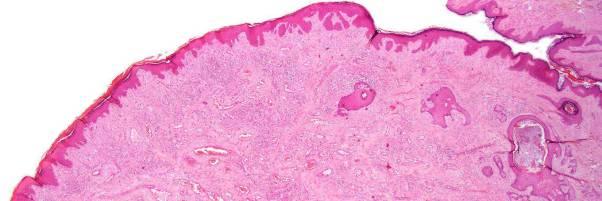 epithelioid endothelial cells (abundant pink
