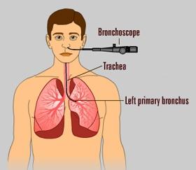 Unit 1: During a bronchoscopy procedure, a scope will be inserted usually through the nostril until it passes through the throat