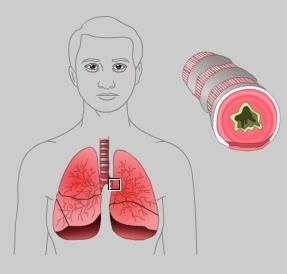 of the bronchial tubes, which can impair breathing.