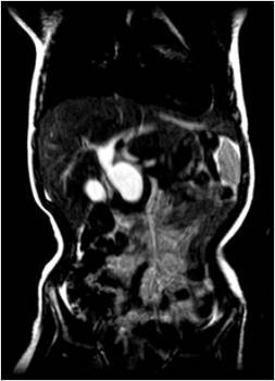 MR Cholangiography showed a cystic fusiform dilatation