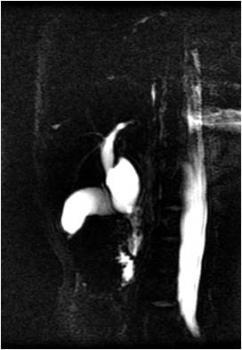 Figure 3 MR Cholangiography Fusiform dilatation of the