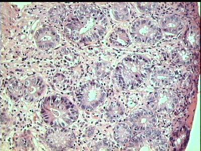 EXUDATIVE CHANGES GRANULAR BASOPHILIC BODIES Colonic biopsy shows a preserved glandular architecture, and inflammatory exudative