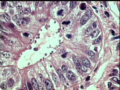 MITOTIC FIGURES ROUNDED PARASITES At higher magnification, the reactive hyperplastic