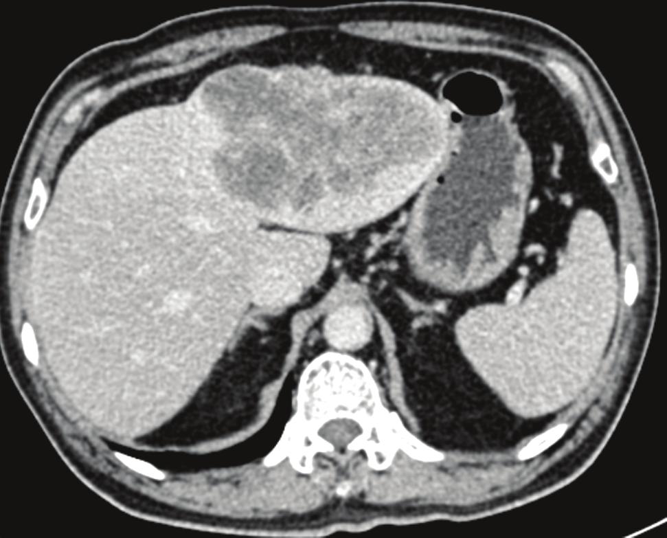 W. C. Lee et al./jcrp 2(2015) 255-260 A 257 B Figure 1. (A) CT scan of liver after enhancement on portal phase revealed a hypodense mass in the left lobe of liver before surgery.