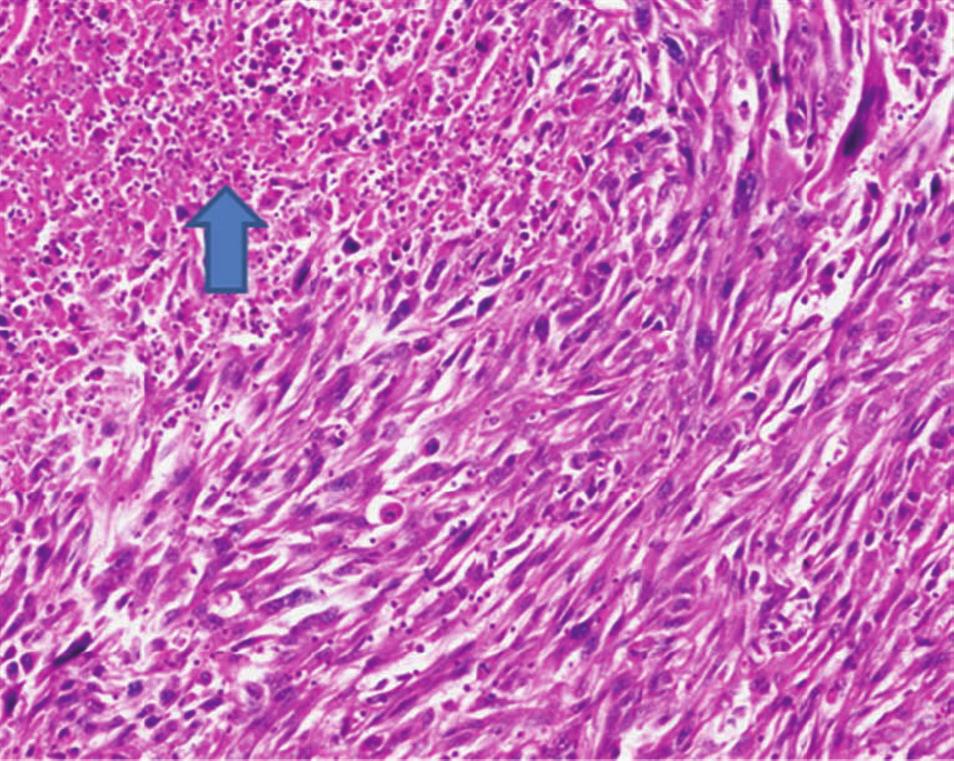 (C) Malignant spindle cells are diffusely positive for vimentin immunohistochemical stain (200X).