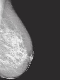 3) which will allow radiologist to scan the breast for asimetry.