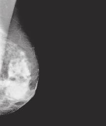 Classic signs of malignancy are spiculated masses or pleomorphic cluster of Fig 1.5. The mammogram of young women. microcalcifications (1.