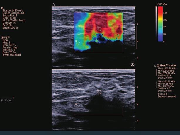 ULTRASOUND When a suspicious finding is detected in breast through a breast self-examination or on a mammogram, the attendingphysician may request an ultrasound of the breast tissue.