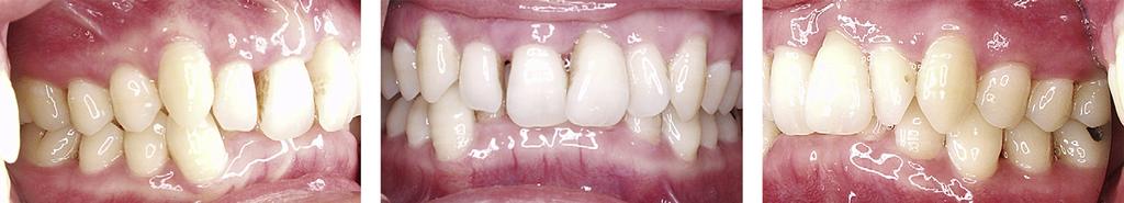 650 Uribe et al American Journal of Orthodontics and Dentofacial Orthopedics November 2010 Fig 1. Pretreatment intraoral photos. Fig 2.