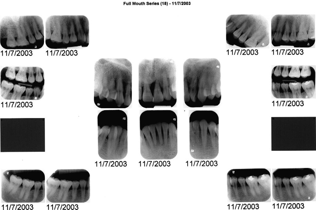 osseous angular defect in the maxillary left incisor was of concern but not directly related to the microbial plaque observed, suggesting that a genetic predisposition might have contributed to the