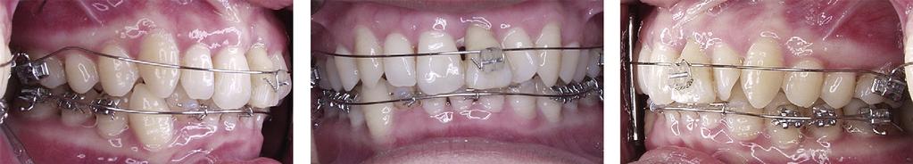 American Journal of Orthodontics and Dentofacial Orthopedics Uribe et al 651 Volume 138, Number 5 Fig 3.