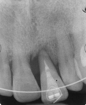 distalizing the maxillary right canine, thereby finishing in a full-cusp Class II molar occlusion on the right and a Class I on the left.