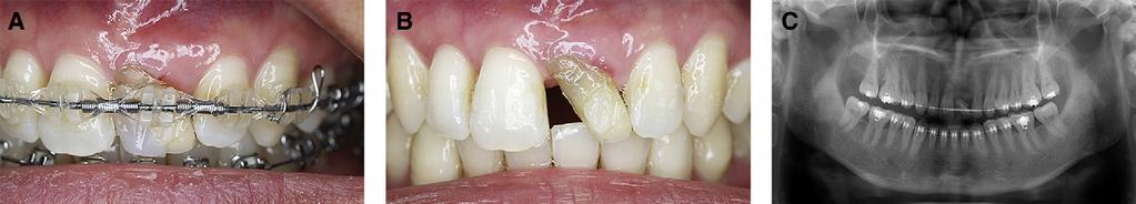 652 Uribe et al American Journal of Orthodontics and Dentofacial Orthopedics November 2010 Fig 5.