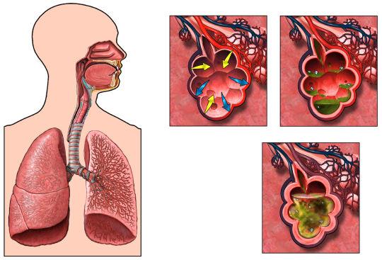 Histopathology Diffuse alveolar damage characterized by: