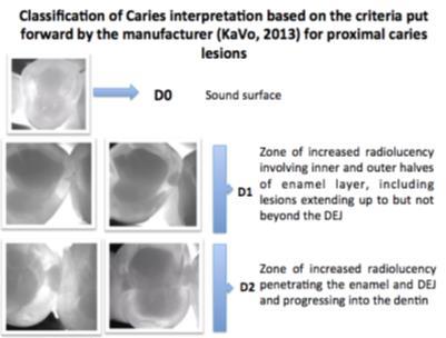 digital sensors, other types of methods are currently used for detection of caries. Nevertheless, 25% 42% of carious lesions remains undetected 3.