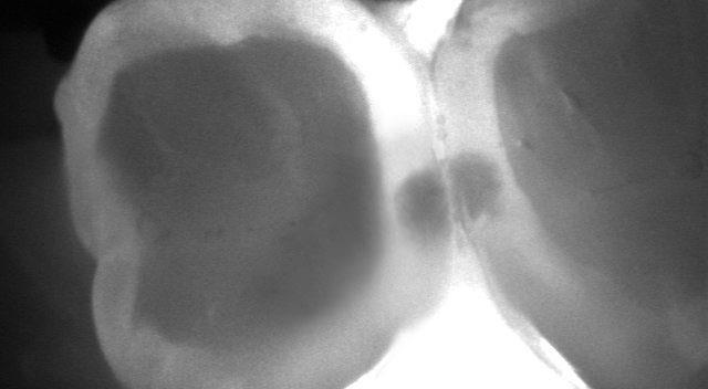 maxillary first and second premolars. Figure 2a Figure 2b Figure 2.