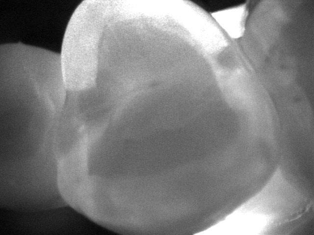 radiography identified 52 surfaces with enamel caries (Figures 3-5).