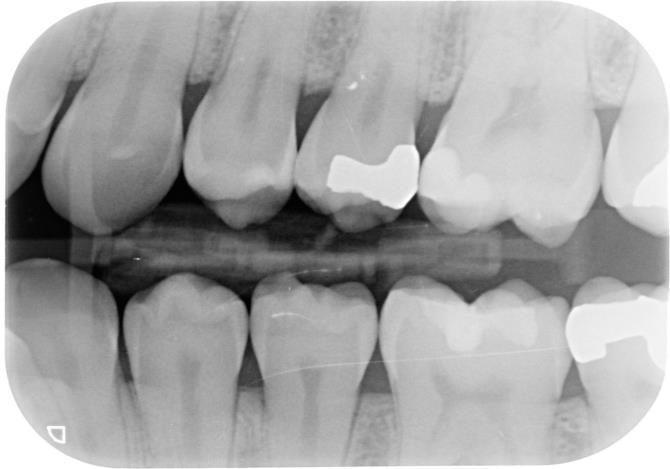 second premolars with dentin caries. Figure 5b Figures 5.