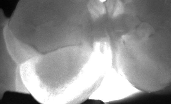 of the same left maxillary first premolar.
