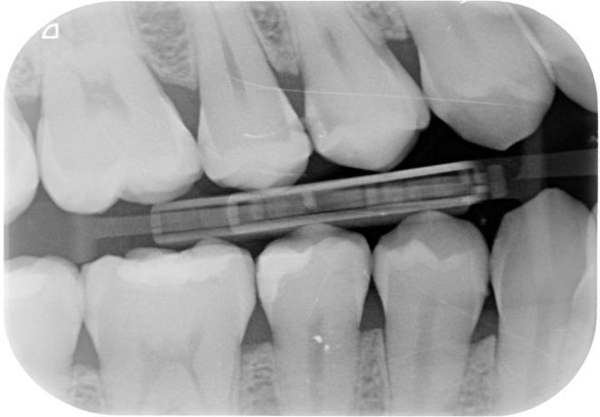 maxillary first and second premolars with dentin caries.
