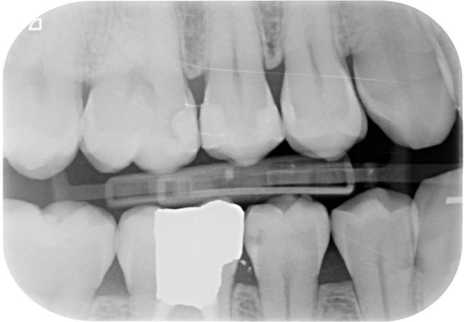 DIAGNOcam (a) image of the right mandibular second premolar showing enamel