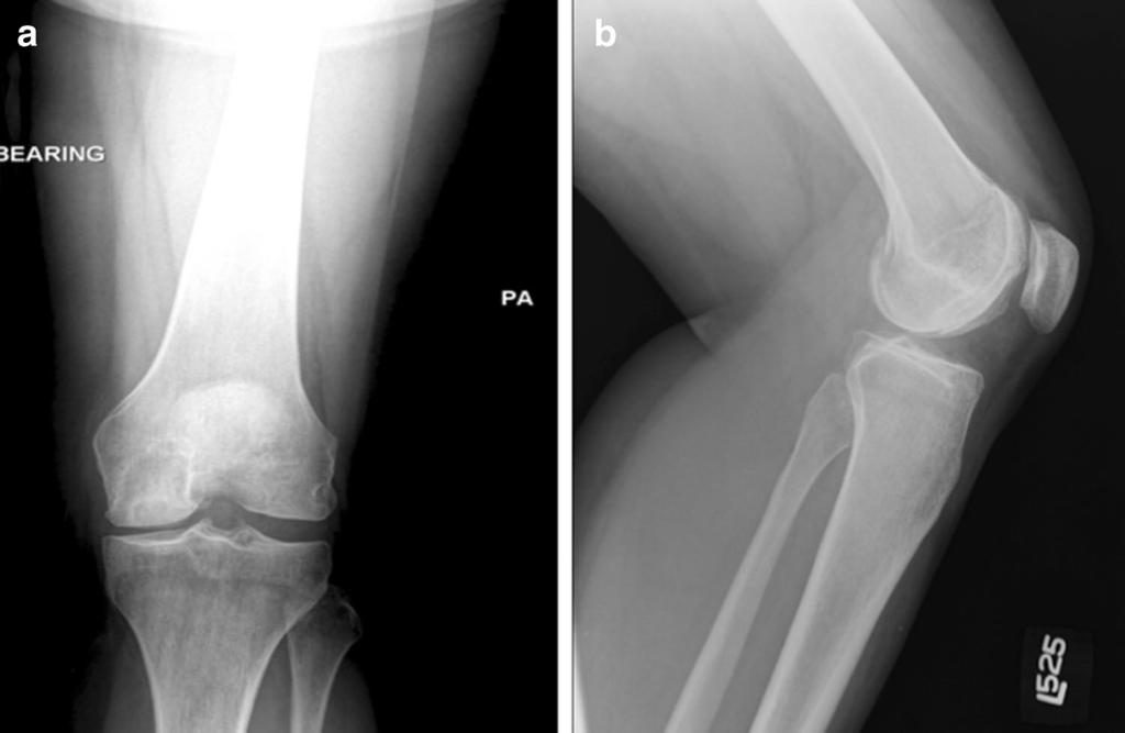 Fig. 4 One-year postoperative radiograph (posterior-anterior [a] and lateral [b]) demonstrating excellent incorporation of the allograft into the medial femoral condyle In cases with complex anatomy