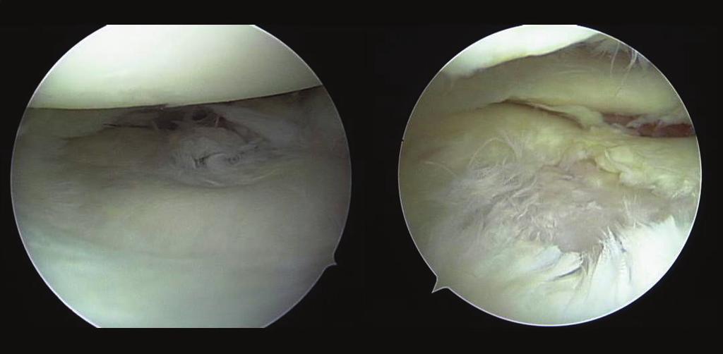 cartilage defect was completely covered with fibrous cartilage (Figure 6),andthepatientwasallowedtorestartplaying sports.