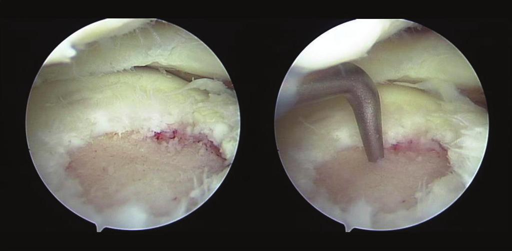 Case Reports in Orthopedics 3 Figure 4: Arthroscopic findings: the damaged cartilage was curetted, and microfracture was performed.