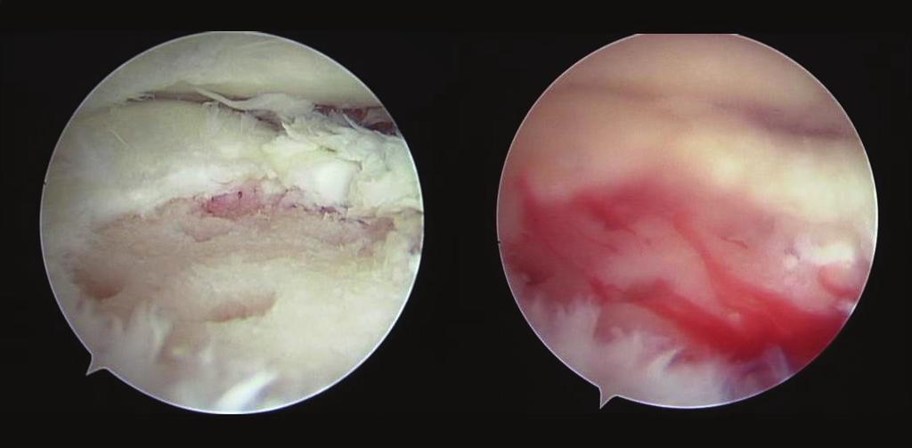 Figure 5: Arthroscopic findings: good hemorrhage from within the bone marrow was confirmed after the tourniquet was released. radiofrequency (RF) ablation [3].