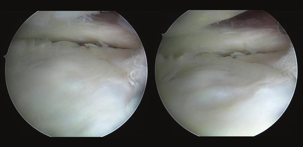 4 Case Reports in Orthopedics Figure 6: Arthroscopic findings 4 months postoperatively: although probing did reveal softening, the cartilage defect was completely covered with fibrous cartilage.