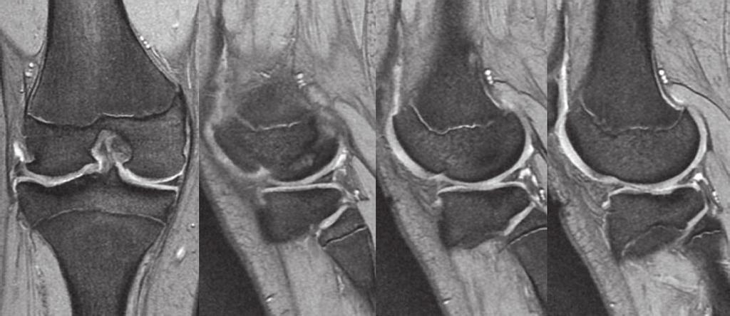 The patient described here had extensive damage to the cartilage of the tibial lateral condyle, measuring around 4cm 2 in area, but arthroscopy four months postoperatively confirmed good cartilage